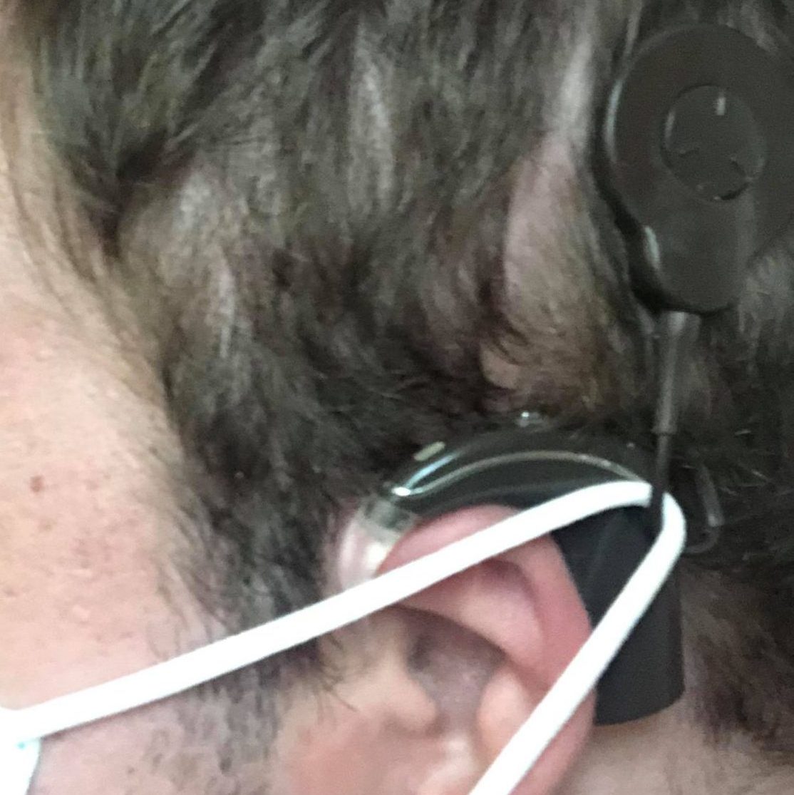 My cochlear implant on the left side of my head.